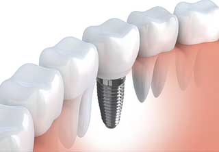 maui oral surgery wisdom teeth
