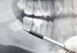 maui oral surgery wisdom teeth